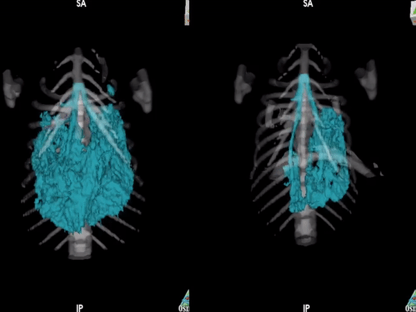 Lung_Cancer.gif
